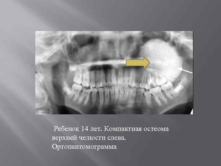 Ребенок 14 лет. Компактная остеома верхней челюсти слева. Ортопантомограмма 