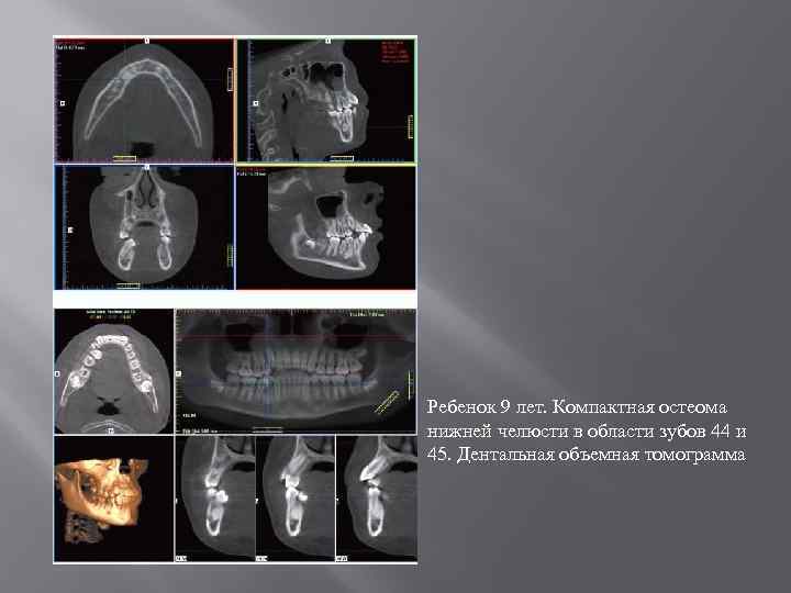 Ребенок 9 лет. Компактная остеома нижней челюсти в области зубов 44 и 45. Дентальная