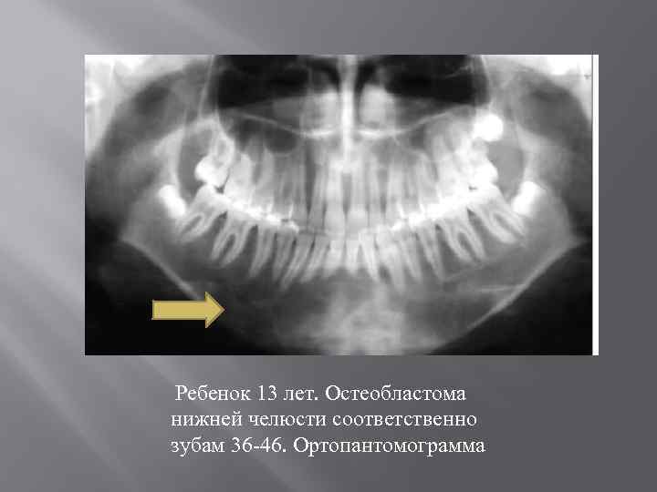 Ребенок 13 лет. Остеобластома нижней челюсти соответственно зубам 36 -46. Ортопантомограмма 