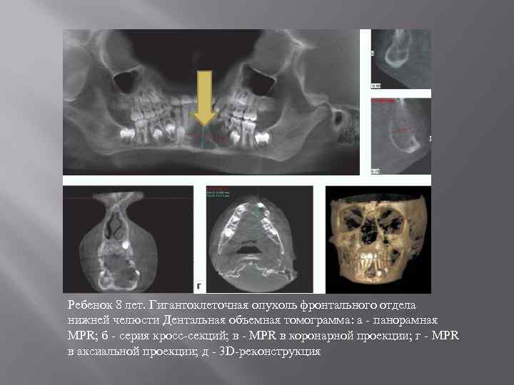 Ребенок 8 лет. Гигантоклеточная опухоль фронтального отдела нижней челюсти Дентальная объемная томограмма: а -