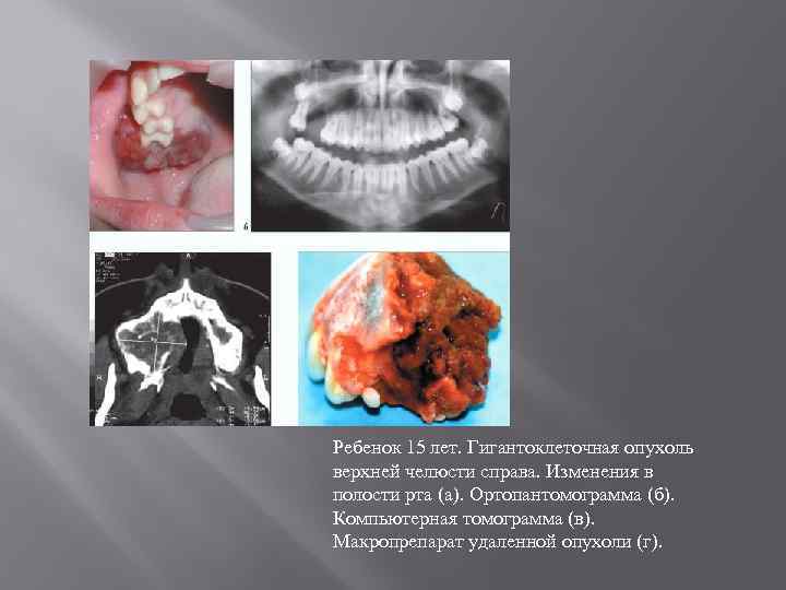 Ребенок 15 лет. Гигантоклеточная опухоль верхней челюсти справа. Изменения в полости рта (а). Ортопантомограмма