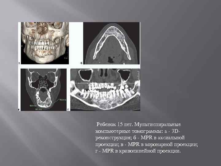 Ребенок 15 лет. Мультиспиральные компьютерные томограммы: а - 3 Dреконструкция; б - MPR в