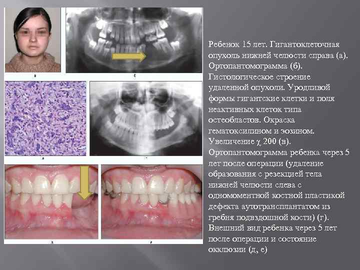 Ребенок 15 лет. Гигантоклеточная опухоль нижней челюсти справа (а). Ортопантомограмма (б). Гистологическое строение удаленной