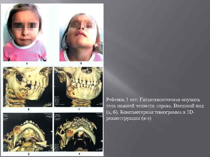 Ребенок 3 лет. Гигантоклеточная опухоль тела нижней челюсти справа. Внешний вид (а, б). Компьютерная