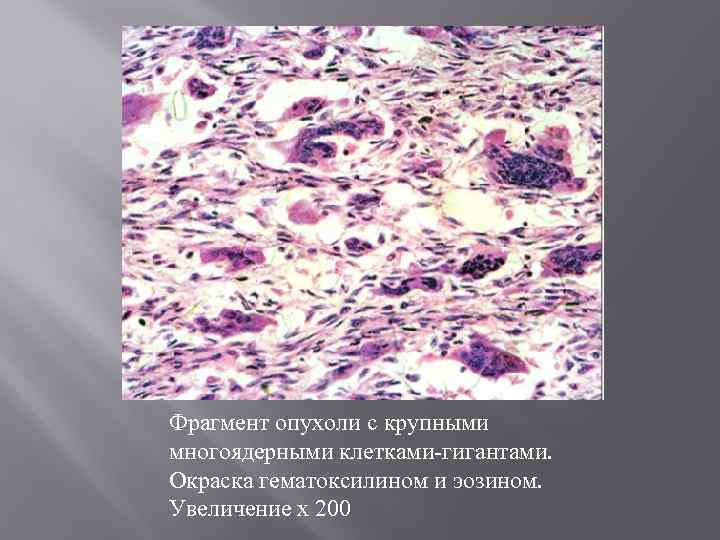Фрагмент опухоли с крупными многоядерными клетками-гигантами. Окраска гематоксилином и эозином. Увеличение x 200 
