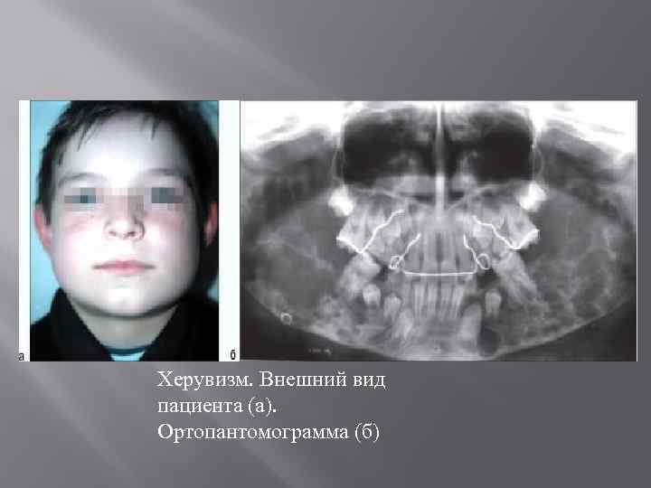 Херувизм. Внешний вид пациента (а). Ортопантомограмма (б) 