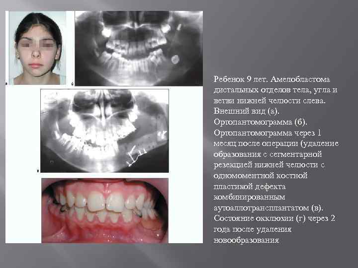 Ребенок 9 лет. Амелобластома дистальных отделов тела, угла и ветви нижней челюсти слева. Внешний