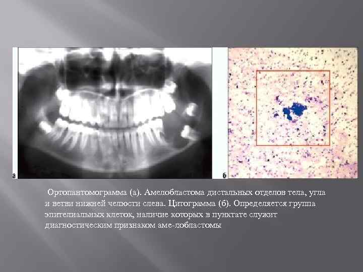 Ортопантомограмма (а). Амелобластома дистальных отделов тела, угла и ветви нижней челюсти слева. Цитограмма (б).