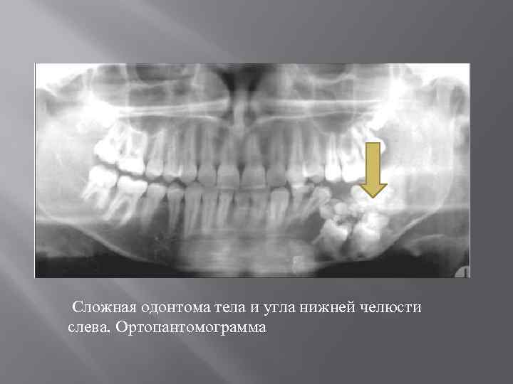 Сложная одонтома тела и угла нижней челюсти слева. Ортопантомограмма 