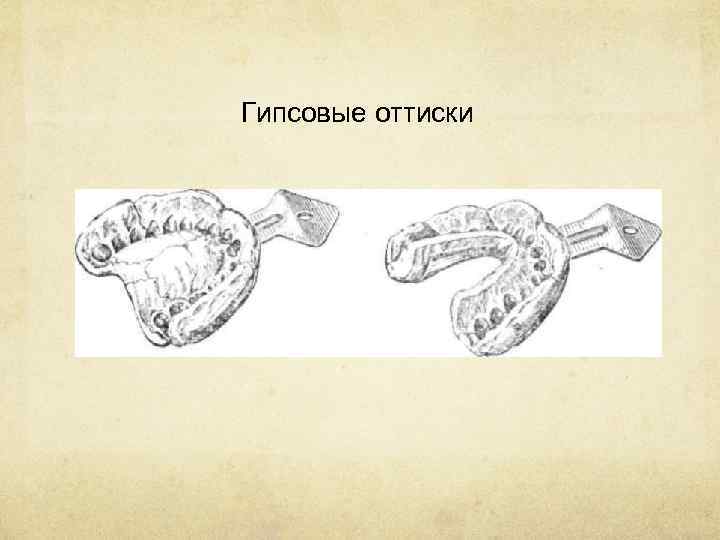 Гипсовые оттиски 