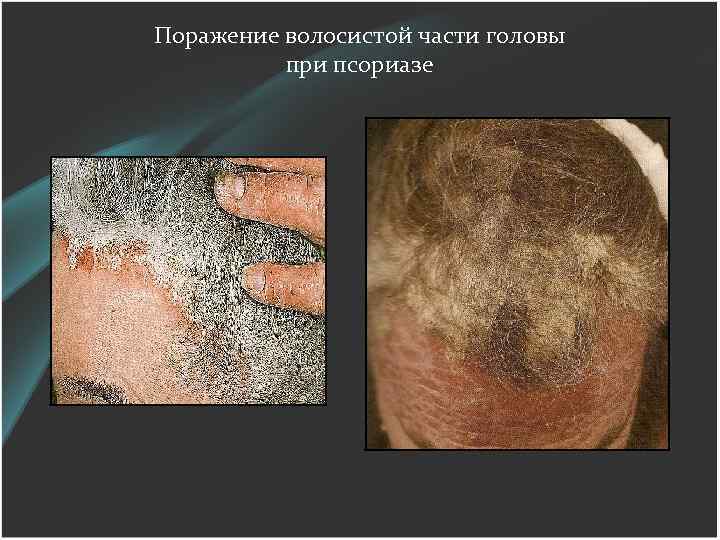 Поражение волосистой части головы при псориазе 