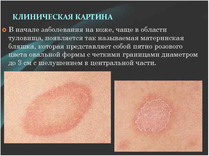 КЛИНИЧЕСКАЯ КАРТИНА В начале заболевания на коже, чаще в области туловища, появляется так называемая