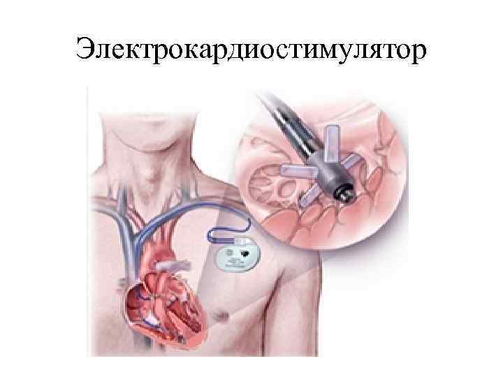 Электрокардиостимулятор 