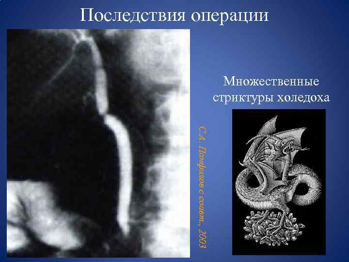 Последствия операции Множественные стриктуры холедоха С. А. Панфилов с соавт. , 2003 