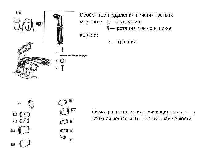 Особенности удаления нижних третьих моляров: а — люксация; б — ротация при сросшихся корнях;