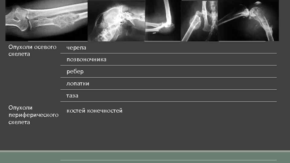 Опухоли осевого скелета черепа позвоночника ребер лопатки таза Опухоли костей конечностей периферического скелета 
