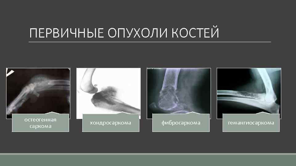 ПЕРВИЧНЫЕ ОПУХОЛИ КОСТЕЙ остеогенная саркома хондросаркома фибросаркома гемангиосаркома 