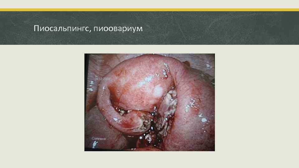 Пиосальпингс, пиоовариум 