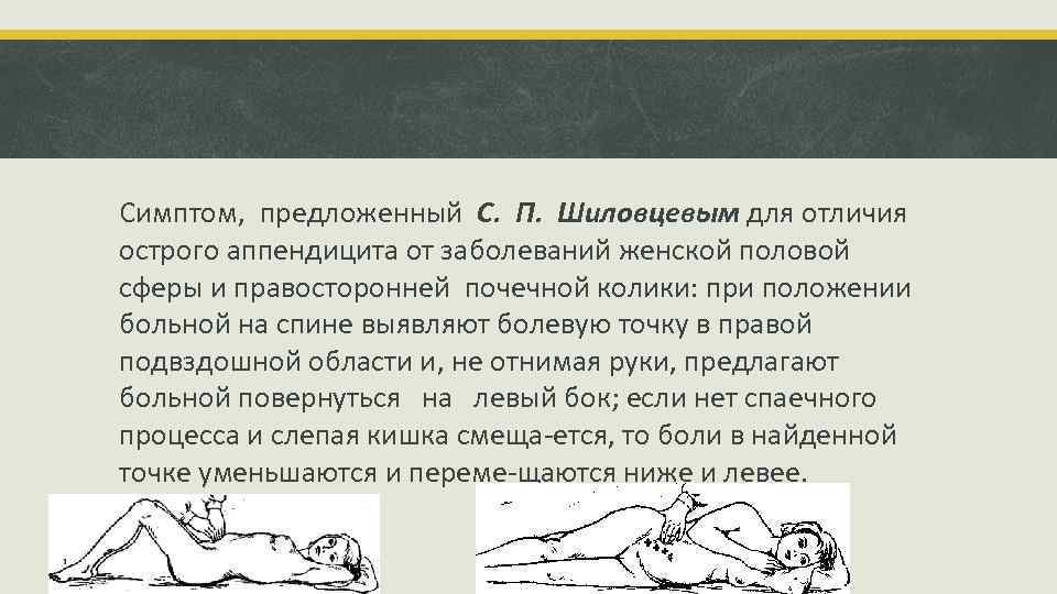 Симптом, предложенный С. П. Шиловцевым для отличия острого аппендицита от заболеваний женской половой сферы
