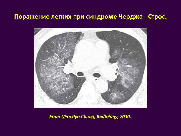 Синдром чарга стросса презентация