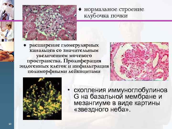 ¨ нормальное строение клубочка почки ¨ расширение гломерулярных канальцев со значительным увеличением мочевого пространства.