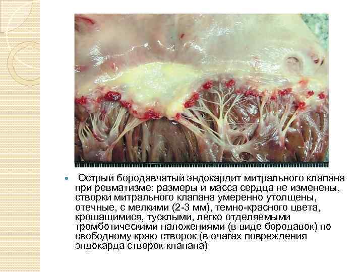  Острый бородавчатый эндокардит митрального клапана при ревматизме: размеры и масса сердца не изменены,