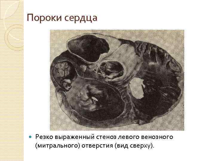 Пороки сердца Резко выраженный стеноз левого венозного (митрального) отверстия (вид сверху). 