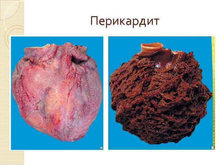 Перикардит 