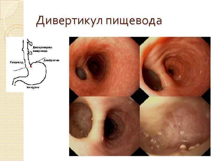 Дивертикул пищевода 