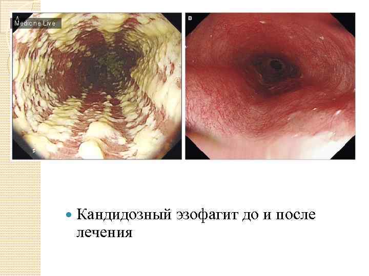  Кандидозный эзофагит до и после лечения 
