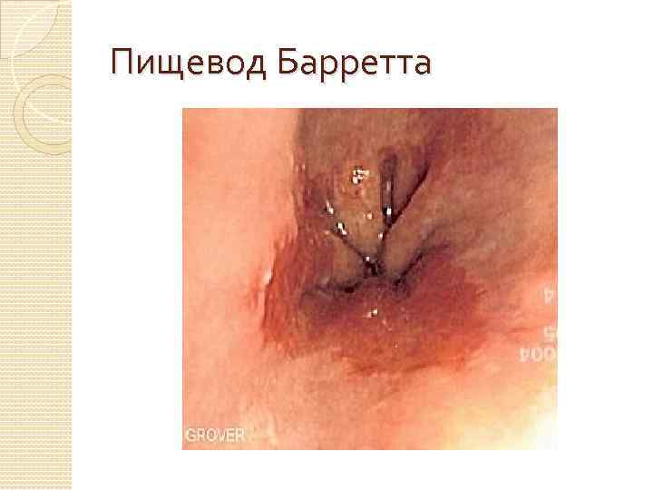 Пищевод Барретта 