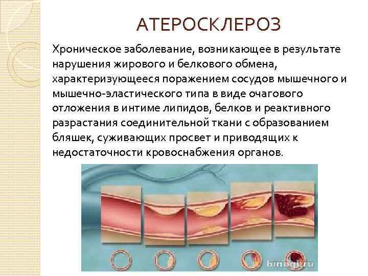 АТЕРОСКЛЕРОЗ Хроническое заболевание, возникающее в результате нарушения жирового и белкового обмена, характеризующееся поражением сосудов