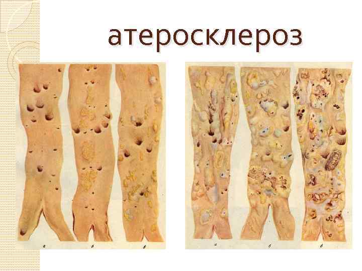 атеросклероз 