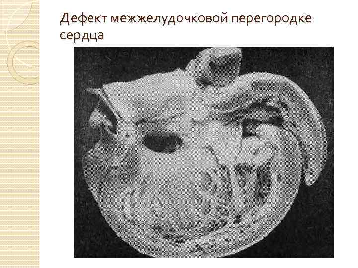 Дефект межжелудочковой перегородке сердца 