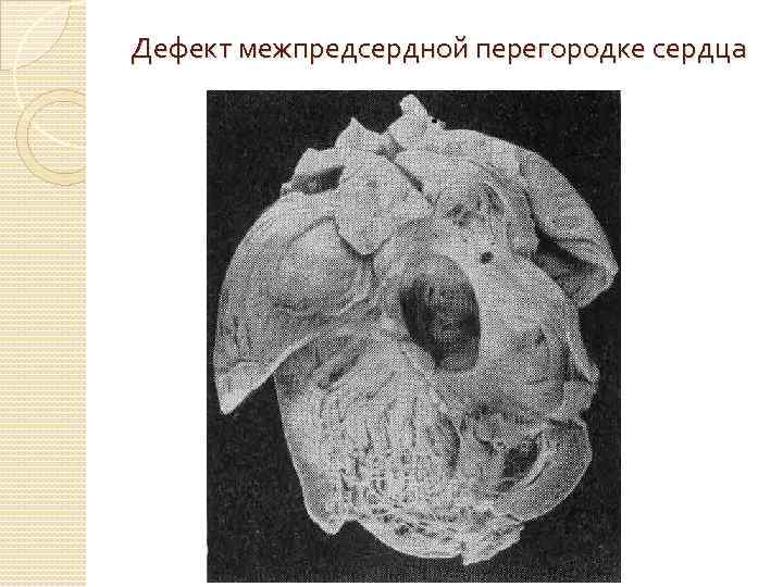 Дефект межпредсердной перегородке сердца 