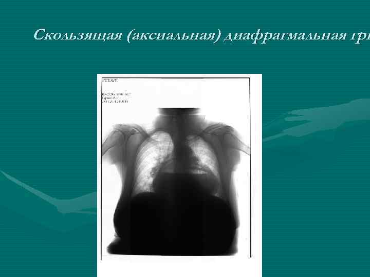 Скользящая (аксиальная) диафрагмальная гры 