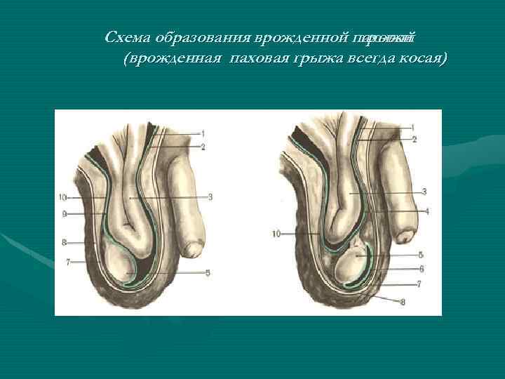 Пахово мошоночная грыжа. Врожденная паховая грыжа схема. Врожденная пахово мошоночная грыжа. Причины образования паховых грыж у детей.