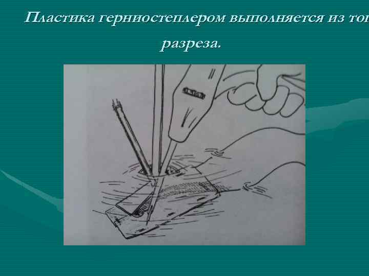 Пластика герниостеплером выполняется из тог разреза. 