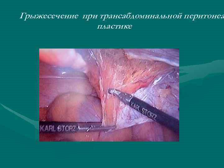 Грыжесечение при трансабдоминальной перитонеа пластике 