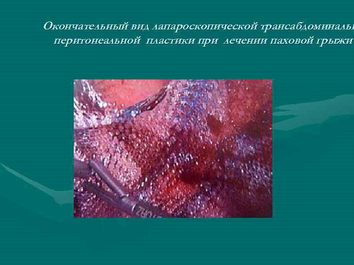 Окончательный вид лапароскопической трансабдоминальн перитонеальной пластики при лечении паховой грыжи 