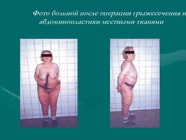 Фото больной после операции грыжесечения и абдоминопластики местными тканями 