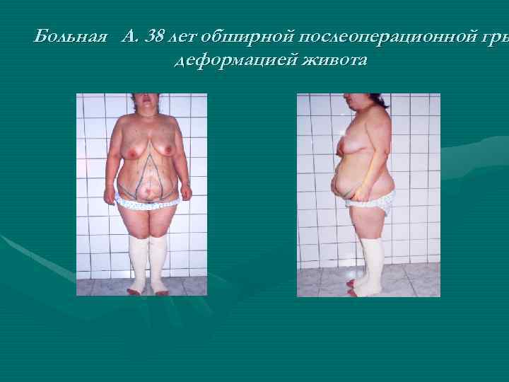 Больная А. 38 лет обширной послеоперационной гры деформацией живота 