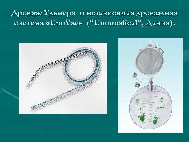 Дренаж Ульмера и независимая дренажная система «Uno. Vac» (“Unomedical”, Дания). 
