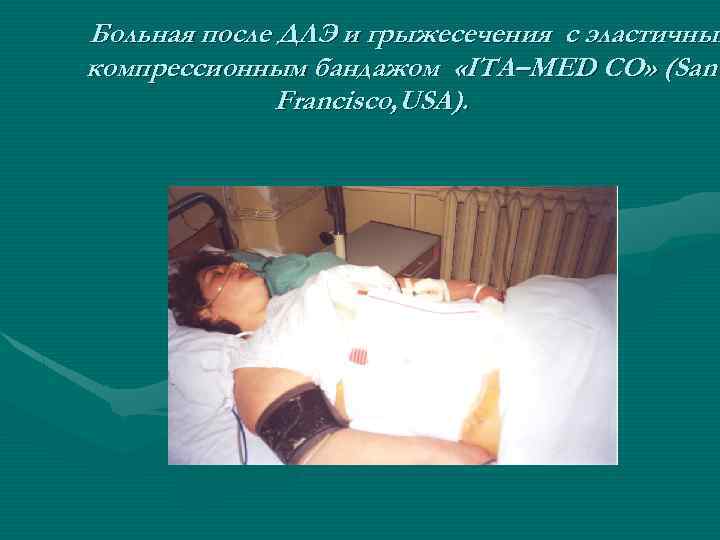 Больная после ДЛЭ и грыжесечения с эластичным компрессионным бандажом «ITA–MED CO» (San Francisco, USA).