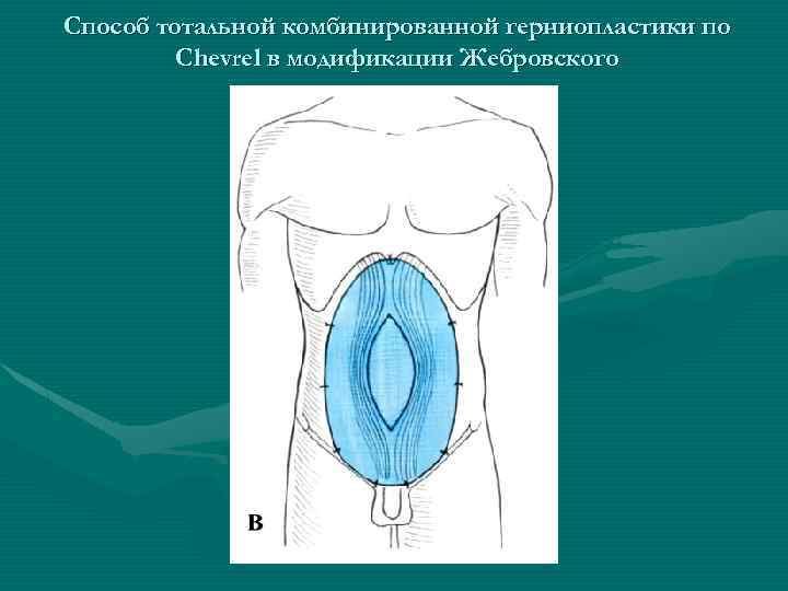 Способ тотальной комбинированной герниопластики по Chevrel в модификации Жебровского 