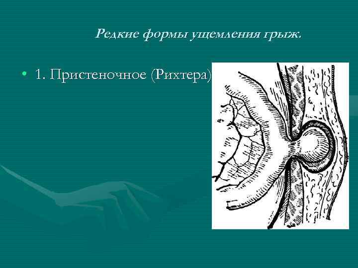 Редкие формы ущемления грыж. • 1. Пристеночное (Рихтера) 