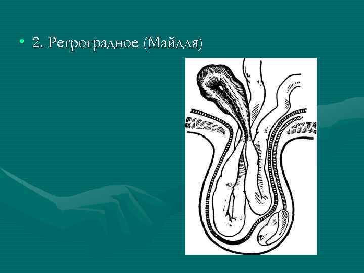  • 2. Ретроградное (Майдля) 