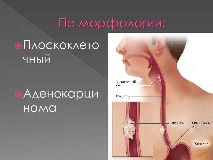 По морфологии: Плоскоклето чный Аденокарци нома 