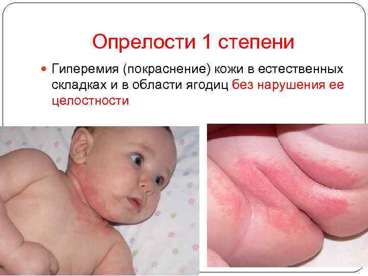 Опрелости 1 степени Гиперемия (покраснение) кожи в естественных складках и в области ягодиц без