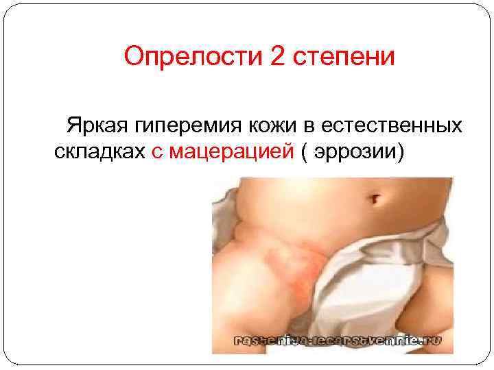 Опрелости 2 степени Яркая гиперемия кожи в естественных складках с мацерацией ( эррозии) 